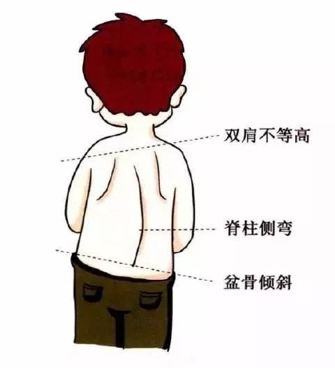 怎样预防强直性脊柱炎脊柱变形,脊椎病的预防