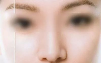 割了双眼皮内眼角有时痒刺痛,女人割双眼皮后眼睛睁不开怎么办