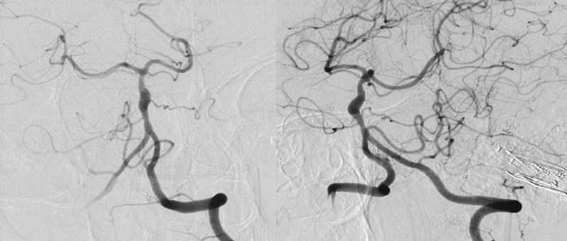 穆如清风·第13期｜Tubridge治疗基底动脉巨大夹层动脉瘤