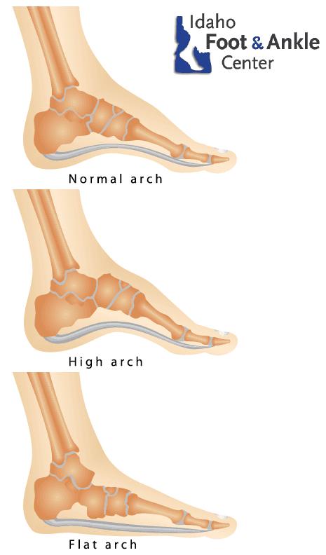 鸭脚板和扁平足的区别,鸭脚板是不是扁平足