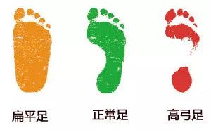 鸭脚板和扁平足的区别,鸭脚板是不是扁平足