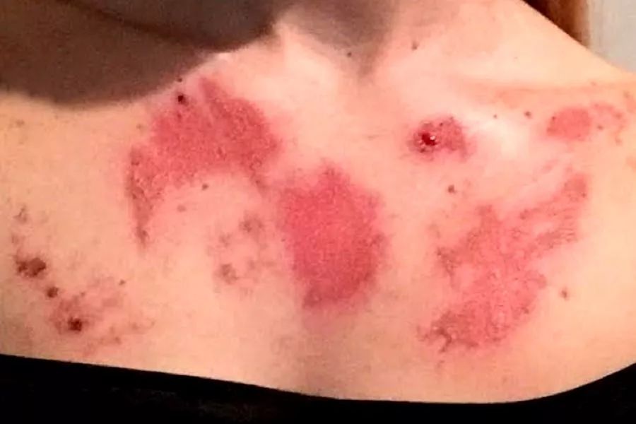 厌食症黄疸,厌食症身体烫咳嗽