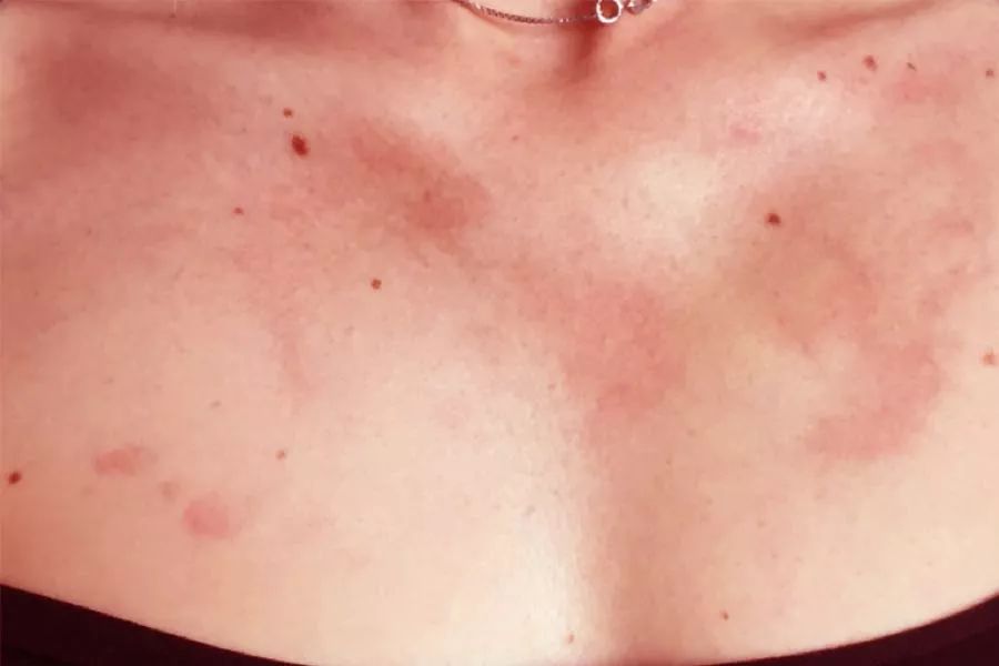 厌食症黄疸,厌食症身体烫咳嗽