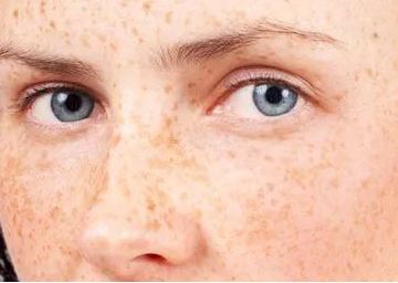 祛斑首选护肤品,祛斑最好的克星