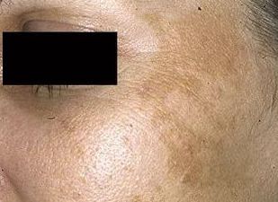 祛斑首选护肤品,祛斑最好的克星