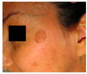 祛斑首选护肤品,祛斑最好的克星