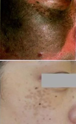 祛斑首选护肤品,祛斑最好的克星