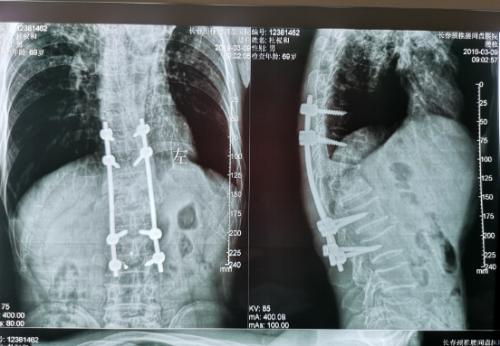 长春传染病医院结核科,结核病长春市权威医院