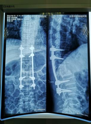 长春传染病医院结核科,结核病长春市权威医院