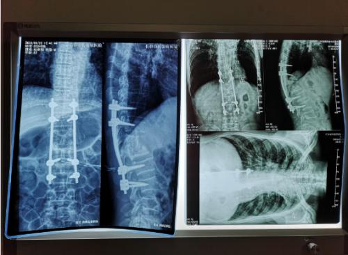 长春传染病医院结核科,结核病长春市权威医院