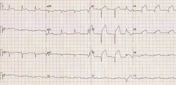18岁突发心梗,18岁心梗