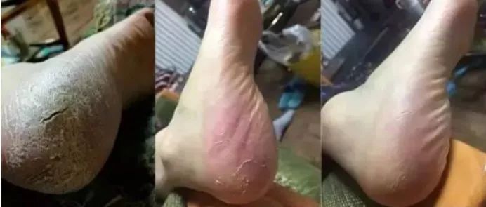 足部护理保湿防干裂去死皮,干燥足部保湿霜