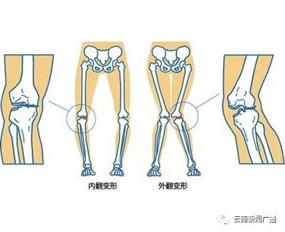 关注自身的健康了解佝偻病的预防,儿童如何快速治好佝偻病
