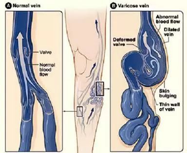 下肢静脉曲张外科手术,日喀则首例静脉曲张微创手术