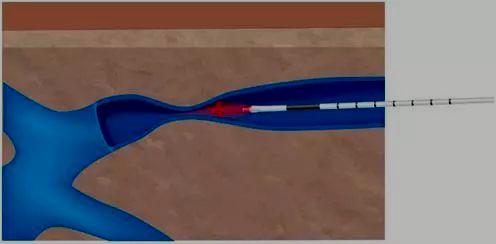 下肢静脉曲张外科手术,日喀则首例静脉曲张微创手术