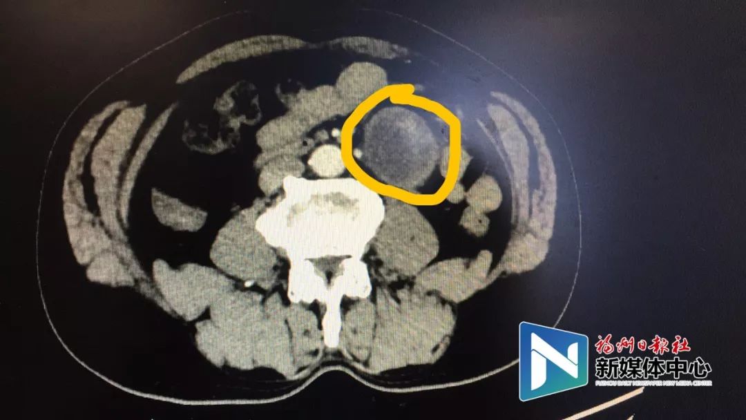 做完手术,福州依伯高血压竟然好了