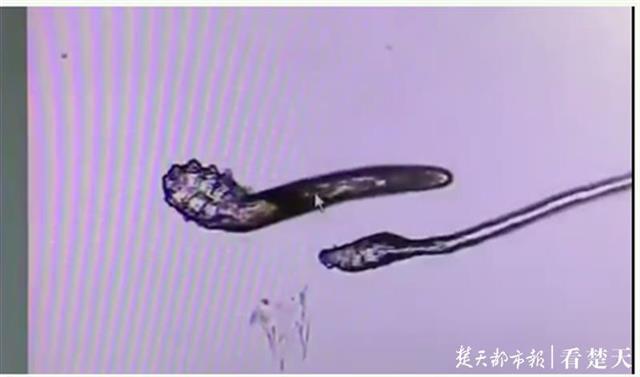 眼睛干痒小心螨虫作祟,眼睛里长螨虫又痛又痒怎么治疗