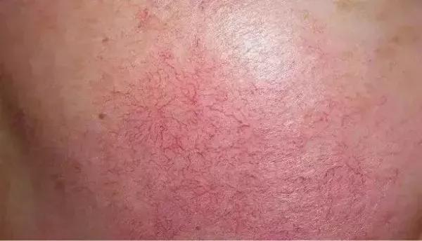 脸部去红血丝的有效方法,去红血丝的有效方法