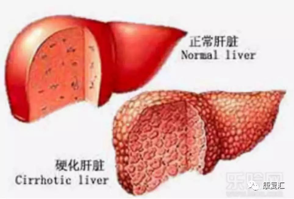 肝硬化康复期中医辨证,肝硬化腹水能彻底康复吗