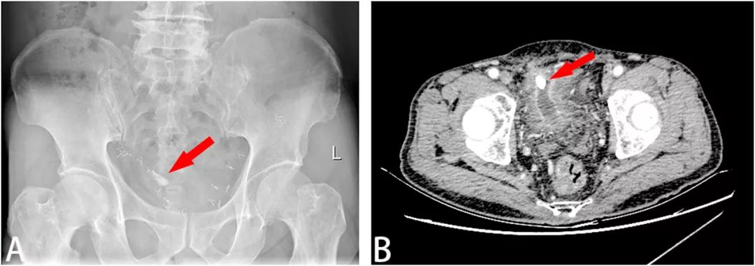 膀胱结石有误诊情况吗,膀胱结石的真实案例