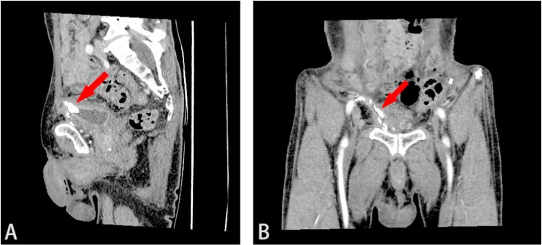 膀胱结石有误诊情况吗,膀胱结石的真实案例