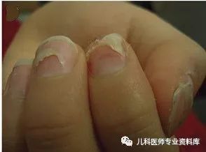 林俊杰嘴里起溃疡是什么原因,手足口不断长新疱疹