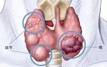 甲状腺癌如何看结节位置,如何分辨甲状腺癌与结节