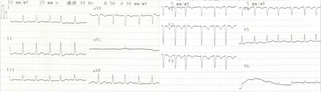 专栏丨贾卫滨：心电图“掉头”现象的鉴别诊断与发生机制（3）