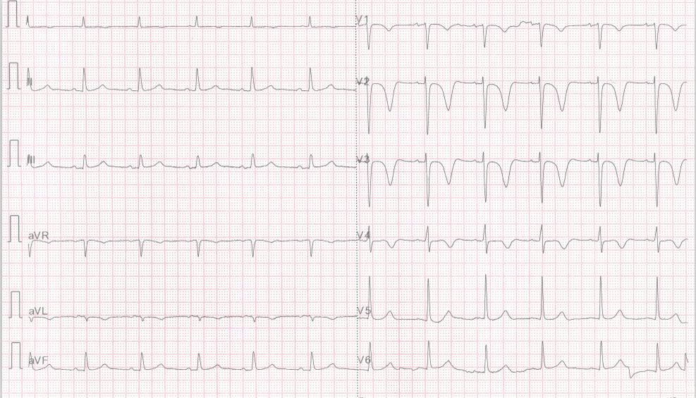 专栏丨贾卫滨：心电图“掉头”现象的鉴别诊断与发生机制（3）