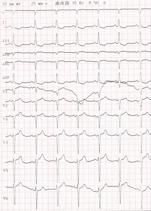 专栏丨贾卫滨：心电图“掉头”现象的鉴别诊断与发生机制（3）