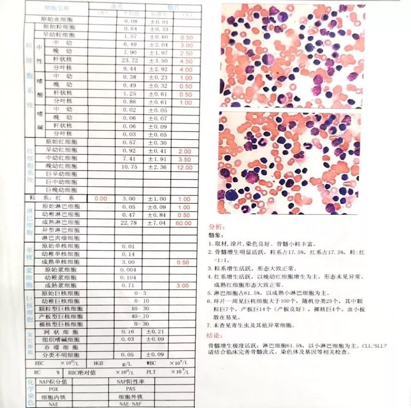 套细胞淋巴瘤胸腔侵润病例分享
