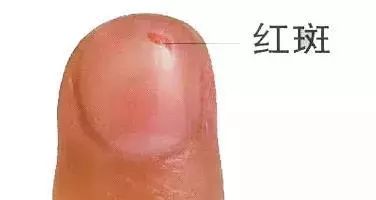 科普|指甲的状态反映了你身体的状况