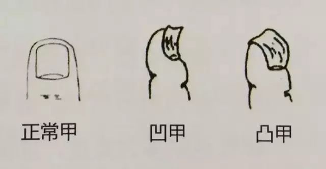 科普|指甲的状态反映了你身体的状况