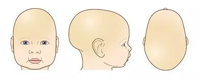 婴儿头睡扁纠正示意图,小孩的头睡扁了怎么办