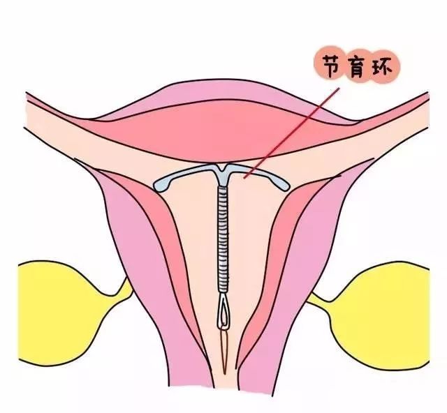 宫内节育环对女性危害,宫内环不取可以吗