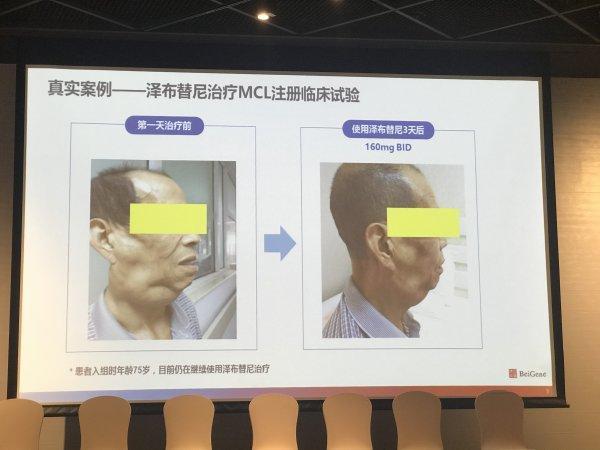 杭州两所医院参与试验解密抗癌新药泽布替尼