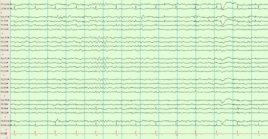 脑电图伪差图,脑电图伪差图谱