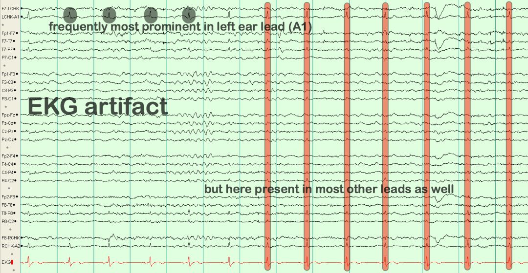 脑电图伪差图,脑电图伪差图谱