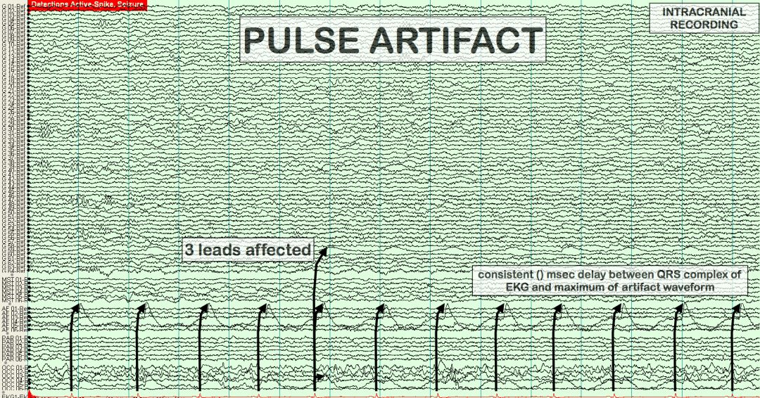 脑电图伪差图,脑电图伪差图谱