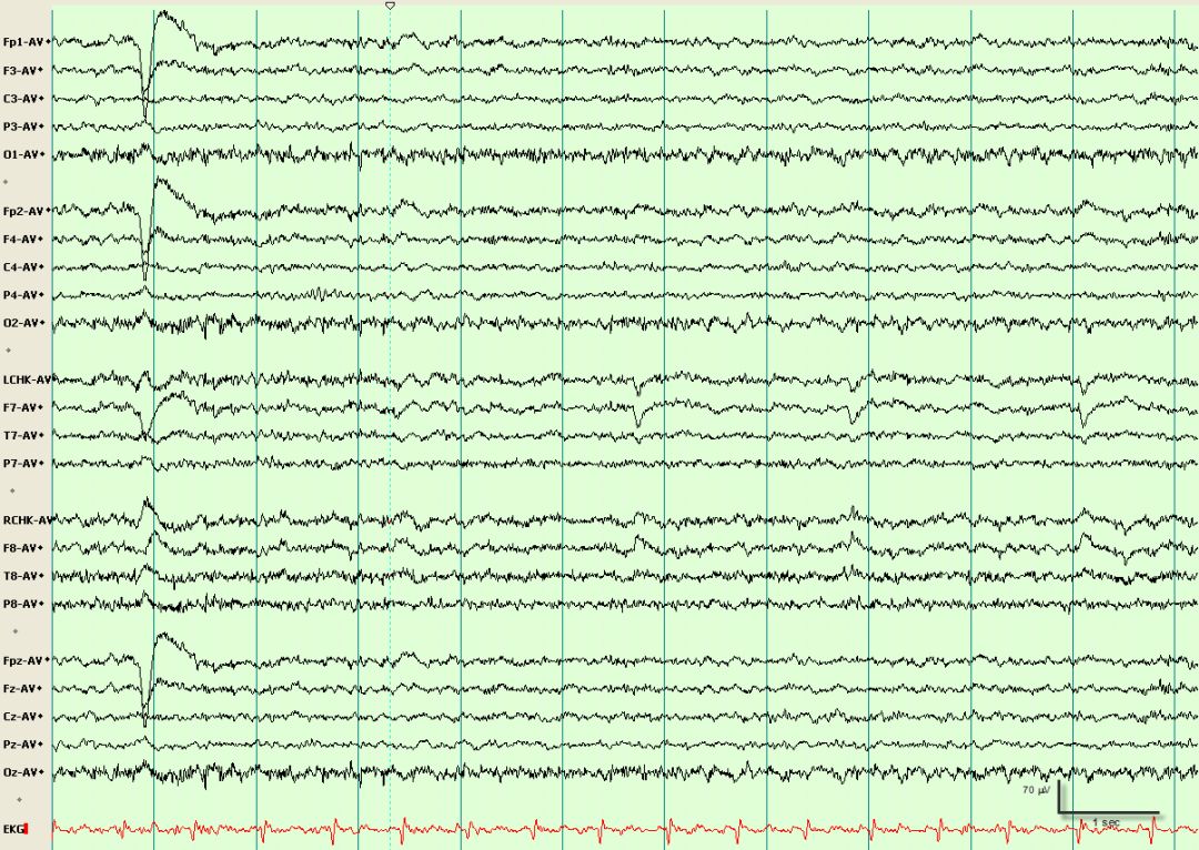 脑电图伪差图,脑电图伪差图谱