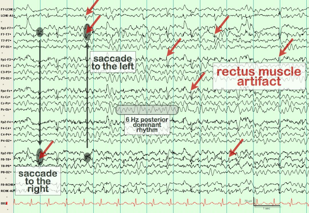 脑电图伪差图,脑电图伪差图谱