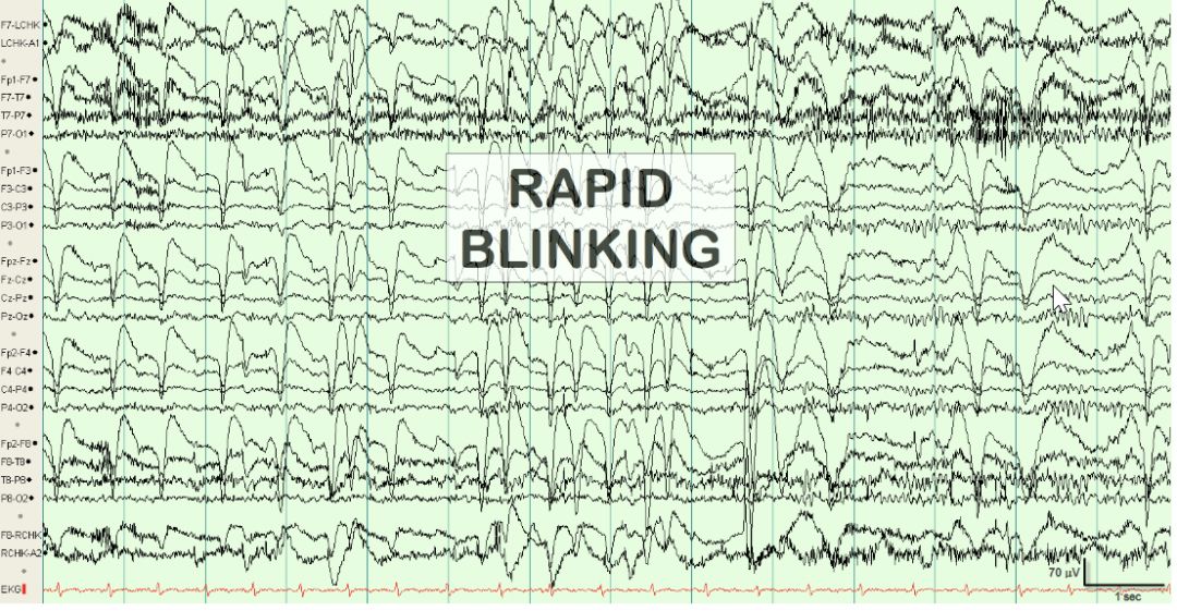 脑电图伪差图,脑电图伪差图谱