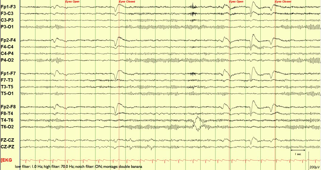 脑电图伪差图,脑电图伪差图谱