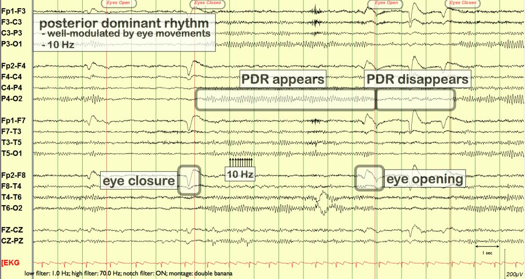 脑电图伪差图,脑电图伪差图谱