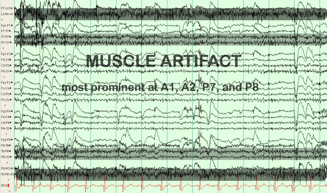 脑电图伪差图,脑电图伪差图谱