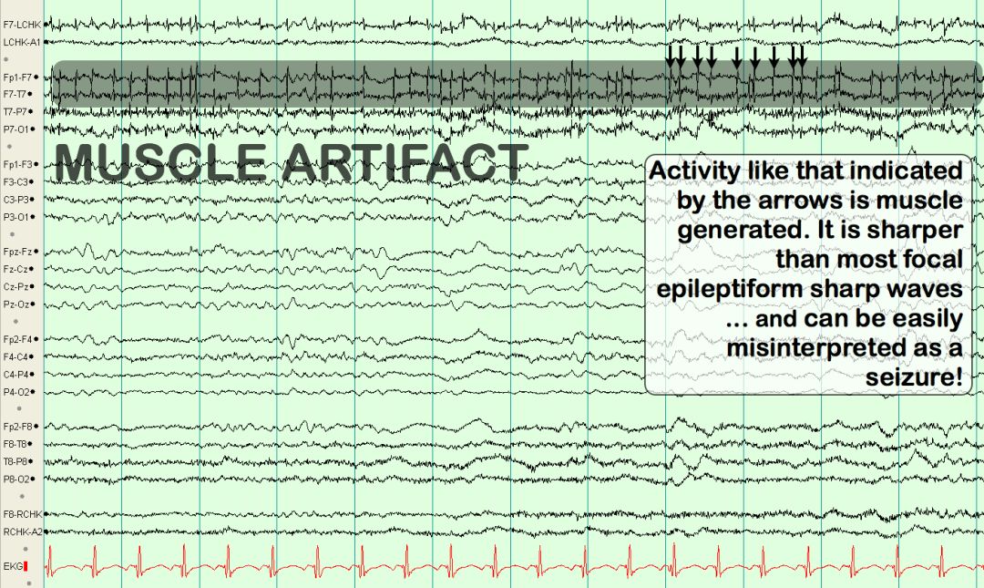 脑电图伪差图,脑电图伪差图谱