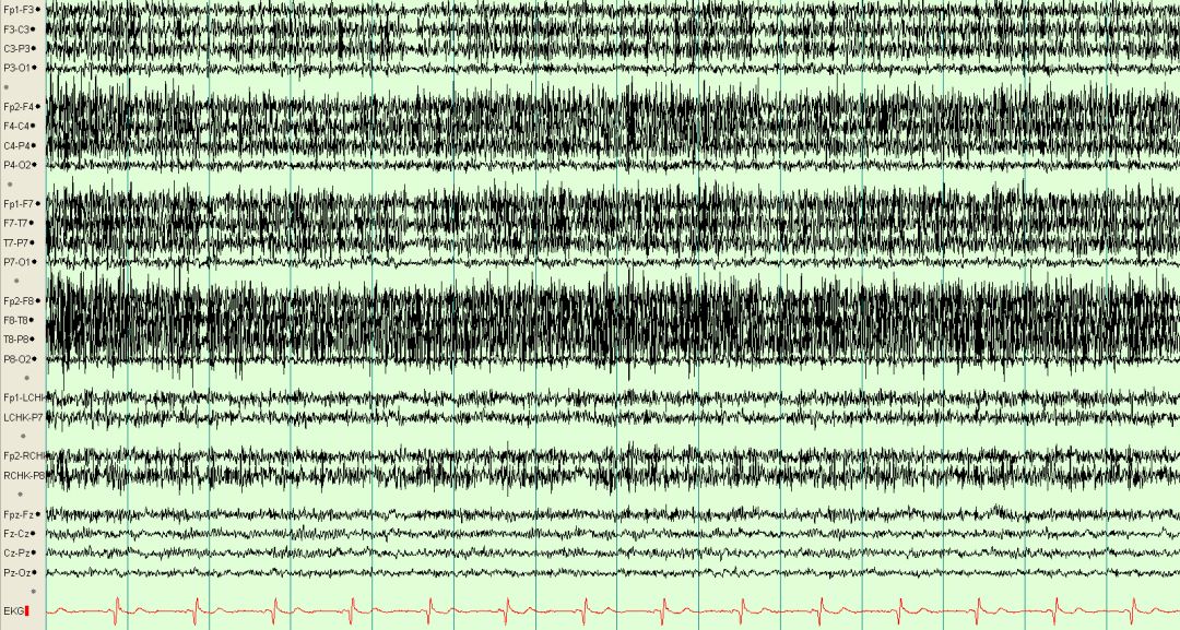 脑电图伪差图,脑电图伪差图谱