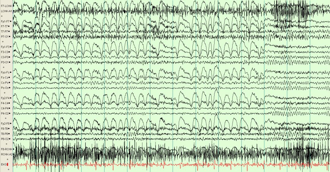 脑电图伪差图,脑电图伪差图谱
