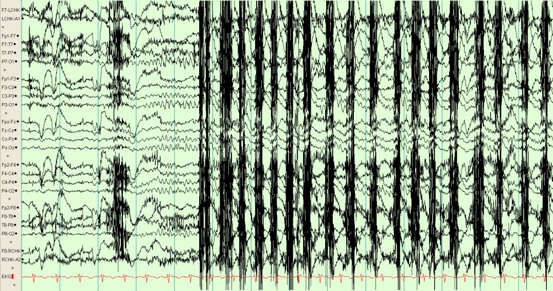 脑电图伪差图,脑电图伪差图谱