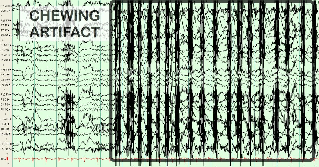 脑电图伪差图,脑电图伪差图谱